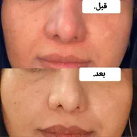 بوتاکس صورت ومعده ژل تزریق چربی عمل پلک ساکشن غبغب|خدمات آرایشگری و زیبایی|یزد, |دیوار