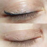 ریموو و پاک کردن تخصصی تاتو توسط مستر ریموو|خدمات آرایشگری و زیبایی|تهران, دهکده المپیک|دیوار