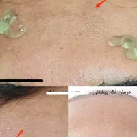فشیال پوست تقویت مو در مطب زیبایی .بانوان -اقایان