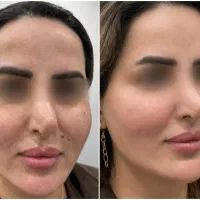 ساخت ژل جوان کننده پرکننده ازخون اولین بار دربوشهر