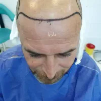 کاشت مو تخصصی دلربا|خدمات آرایشگری و زیبایی|حمیدیه, |دیوار