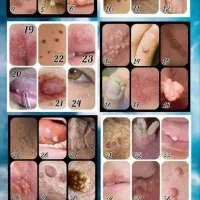 درمان قطعی زگیل و تبخال