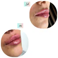 جشنواره تزریق ژل بدون درد و کبودی تضمینی