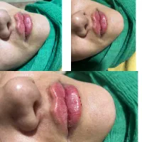 ژل بوتاکس|خدمات آرایشگری و زیبایی|دورود, |دیوار