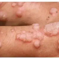 درمان خانگی زگیل و تبخال تناسلی