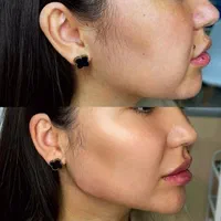 کلینیک تزریق ژل لب روسیm مادلینگ mdبوتاکس لیزر|خدمات آرایشگری و زیبایی|تهران, صادقیه|دیوار