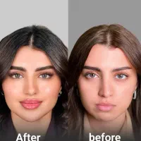 فیلر ژل لیزر پلاژن پی ارپی هایفو صورت زاویه فک