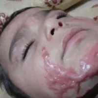 مشاوره درموردسوختگی کودکان