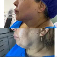 ساکشن غبغب و شکم فیلر بادی پی ار پی ژل و بوتاکس|خدمات آرایشگری و زیبایی|شیراز, قصرالدشت|دیوار