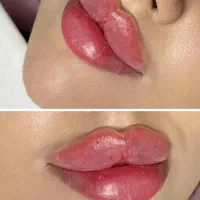 تخفیفات ژل و بوتاکس ومزوتراپی (آموزش۴ونیم)