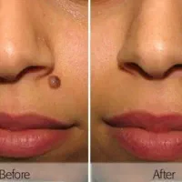 خالبرداری وژل و بوتاکس و پرسینگ