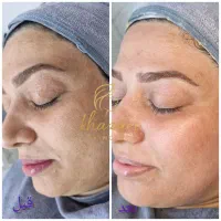 فیشال صورت و بدن