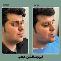 لیپو ساکشن غبغب و بوکال فت ( + شرایط )|خدمات آرایشگری و زیبایی|مشهد, گلبرگ شمالی|دیوار
