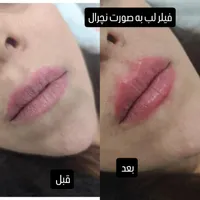 مدت محدود آموزش کامپوزیت دندان لیرینگ لب شیشه‌ای|خدمات آرایشگری و زیبایی|کرج, چهارصد دستگاه|دیوار