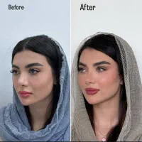 تزریق و اموزش ژل و بوتاکس