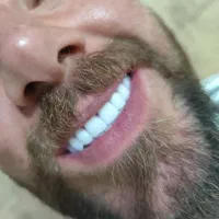 دندان مصنوعی طرح کامپوزیت و لمینت هر فک ۵ تومان|خدمات آرایشگری و زیبایی|کرج, کمالشهر|دیوار