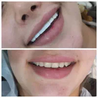 کامپوزیت زیبایی دندان درکلینیک دندانپزشکی|خدمات آرایشگری و زیبایی|یاسوج, |دیوار