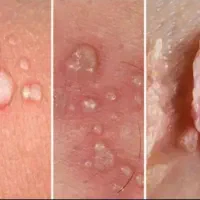 رفع دائمی و ریشه ای زگیل و تبخال