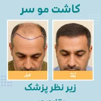 پیوند/ مو ابرو / روش DHI / با خط رویش پنهان|خدمات آرایشگری و زیبایی|تهران, دروس|دیوار