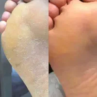 پدیکور اقتصادی وفوق‌العاده تمیزو موخوره گیری تخصصی
