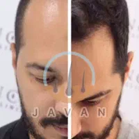 کاشت مو ابرو بلفاروپلاستی مزو تراپی پی آرپی|خدمات آرایشگری و زیبایی|تهران, صادقیه|دیوار