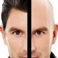 کاشت مو ابرو و ریش تخفیف ۵۰ درصدی