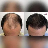 استخدام تکنسین کاشت ابرو/کاشت مو حتی مبتدی کاریابی
