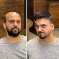 تعویض چسب،خدمات پروتزمودر منزل و محل کارشما
