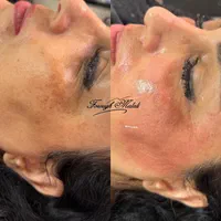 حذف تک جلسه ای لک و کک مک کلینیک|خدمات آرایشگری و زیبایی|رشت, گلسار|دیوار