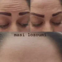 مرکز تخصصی ژل و بوتاکس در قزوین|خدمات آرایشگری و زیبایی|قزوین, |دیوار