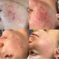 فیشال تخصصی و درمانی صورت و بدن، رفع تیرگی چیتگر|خدمات آرایشگری و زیبایی|تهران, گلستان (شهرک راه آهن)|دیوار