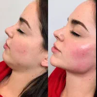 فیلر لب و بوتاکس با پنجاه درصد تخفیف|خدمات زیبایی و سلامت|تهران, صادقیه|دیوار