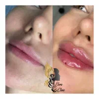 زیبایی ماندگار با خدمات تخصصی ژل و بوتاکس