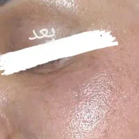 تکنیک بروز پوست کره ای(پوست شیشه ای )