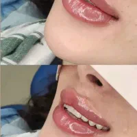 تزریق ژل و بوتاکس