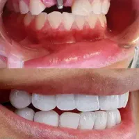 ایمپلنت کره ای دندان  11تومن باضمانت