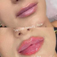 کلینیک تزریق ژل لبروسی390بوتاکسmd codeپرفایلو لیزر|خدمات آرایشگری و زیبایی|تهران, صادقیه|دیوار
