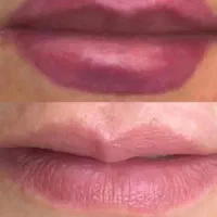 پاک کردن تتو با پیشرفته ترین لیزر کیوسوئیچ|خدمات آرایشگری و زیبایی|اهواز, کوی سعدی|دیوار