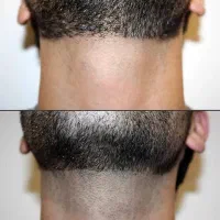 لیزر سه طول موج تیتانیوم اصل فقط اقایون|خدمات آرایشگری و زیبایی|گرگان, |دیوار