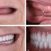 دست دندان اقساطی بهترین کیفیت و قیمت استثنایی|خدمات زیبایی و سلامت|تهران, پاسداران|دیوار