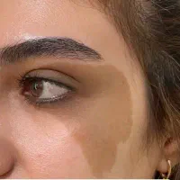 مدل درمان لیزری لک ملاسما تیرگی وایتنینگ تک جلسه