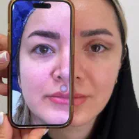 بلفاروپلاستی ساکشن غبغب