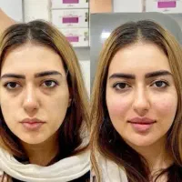 اف یلدایی خدمات ژل و بوتاکس