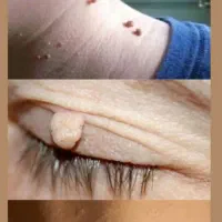 لیزر تمامی خالها و لک ها و زگیل ها تناسلی