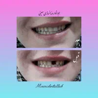 دندانسازی/دست دندان متحرک/سپیدان/هماشهر/همایجان|خدمات آرایشگری و زیبایی|شیراز, گویم|دیوار