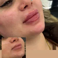 جشنواره تزریق فیلر و بوتاکس و مزوژل تا پایان تیر