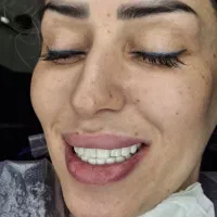 تخفیف ویژه زیبایی دندان