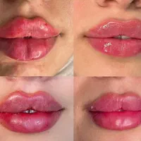 جشنواره تخفیف ۵۰ درصدی تزریق ژل و بوتاکس کره ای