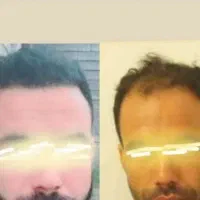 ۵۰٪تخفیف کاشتمو در شیراز|خدمات آرایشگری و زیبایی|خرم‌آباد, |دیوار