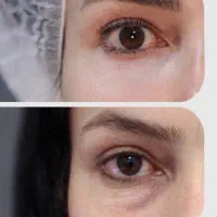 کلینیک فیلرزیرچشم/تیرگی زیرچشم/سوپرلیفت/بوتاکس